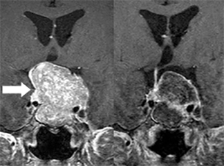 下垂体腺腫[写真]