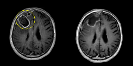 悪性脳腫瘍[写真]