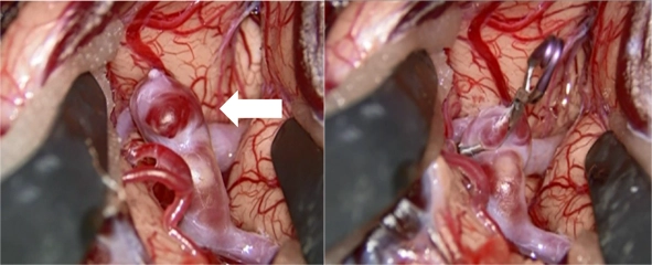 開頭脳動脈瘤クリッピング術[写真]