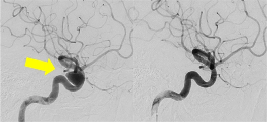 脳動脈瘤塞栓術[写真]