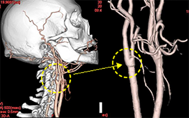頚部内頚動脈内膜剥離術[写真]