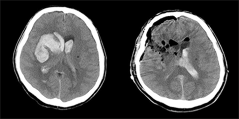 脳出血[写真]
