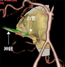 神経血管圧迫症候群[写真]